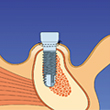 Einschrauben des Implantates und Nahtverschluss